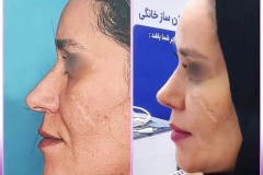 جراحی-بینی-266