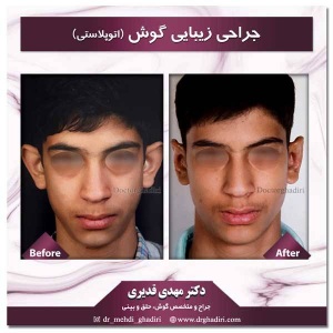جراحی-گوش-در-اصفهان-1