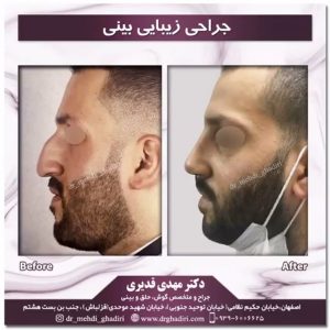 بهترین جراح پلاستیک بینی در اصفهان