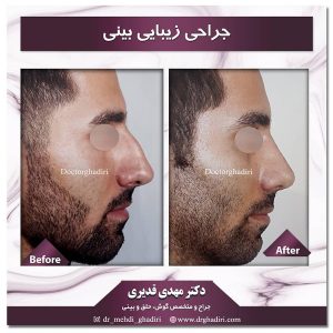 جراحی زیبایی بینی در اصفهان