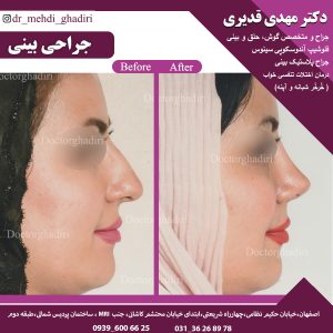 قبل و بعد جراحی بینی