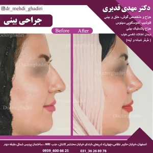 جراحی بینی - دکتر مهدی قدیری