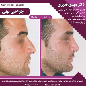 جراحی بینی - دکتر مهدی قدیری