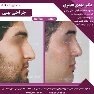 جراحی بینی - دکتر مهدی قدیری