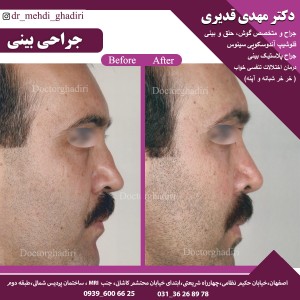 قبل و بعد جراحی بینی