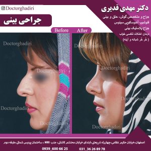 جراحة-الأنف