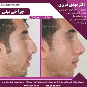 قبل و بعد جراحی بینی