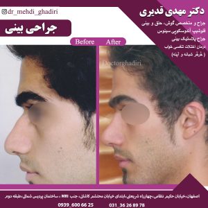 قبل و بعد جراحی بینی