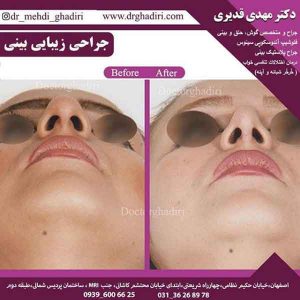 جراحی بینی - دکتر مهدی قدیری