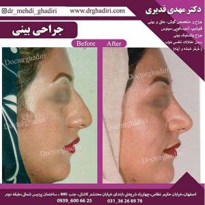 جراحی بینی - دکتر مهدی قدیری