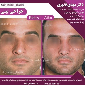 جراحی بینی - دکتر مهدی قدیری