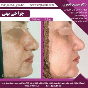 جراحی بینی - دکتر مهدی قدیری