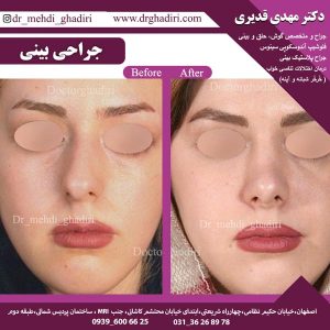 جراحی بینی - دکتر مهدی قدیری