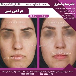 جراحی بینی - دکتر مهدی قدیری