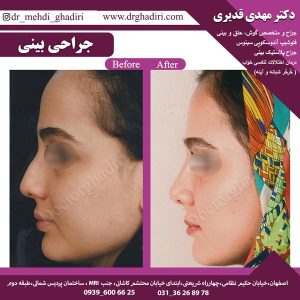 جراحی بینی - دکتر مهدی قدیری