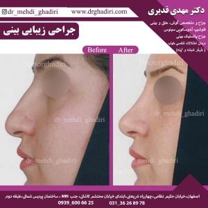 جراحی بینی - دکتر مهدی قدیری