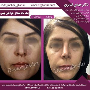 جراحی بینی - دکتر مهدی قدیری