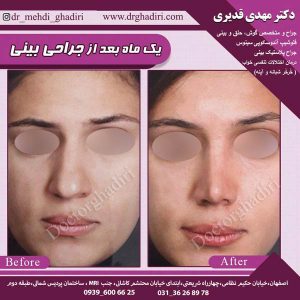 جراحی بینی - دکتر مهدی قدیری