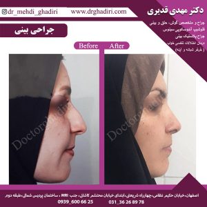جراحی بینی - دکتر مهدی قدیری