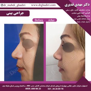 جراحی بینی - دکتر مهدی قدیری