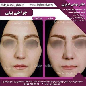 جراحی بینی - دکتر مهدی قدیری