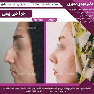 جراحی بینی - دکتر مهدی قدیری