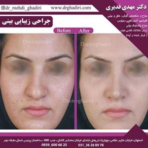 قبل و بعد از جراحی بینی