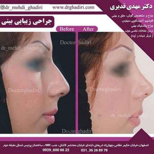 جراحی بینی - دکتر قدیری