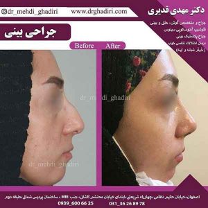 جراحی بینی-دکتر مهدی قدیری
