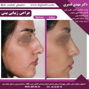 جراحی بینی- دکتر مهدی قدیری