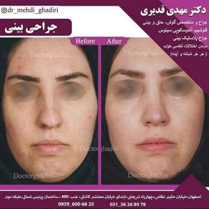 جراحی بینی- دکتر مهدی قدیری