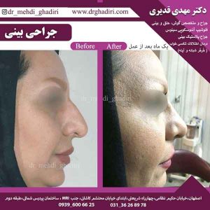 جراحی بینی - دکتر مهدی قدیری