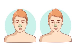 تأثیر جراحی بینی بر تنفس و خواب