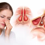 تأثیر انحراف تیغه بینی (سپتوم) بر آپنه خواب و خر و پف