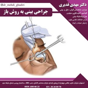 جراحی بینی به روش باز