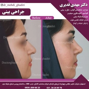 قبل و بعد جراحی بینی