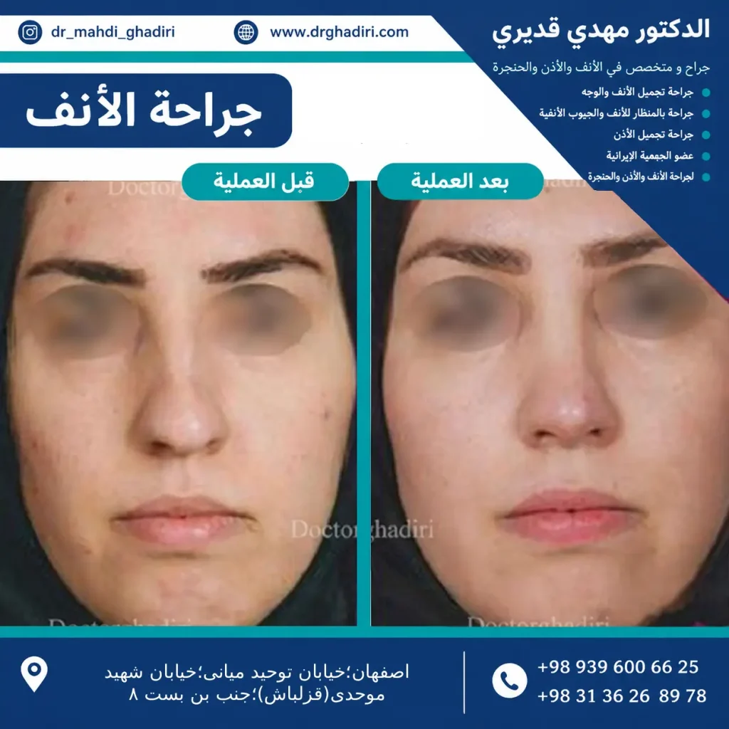 جراحة تجميل الأنف - الدكتور مهدي قديري