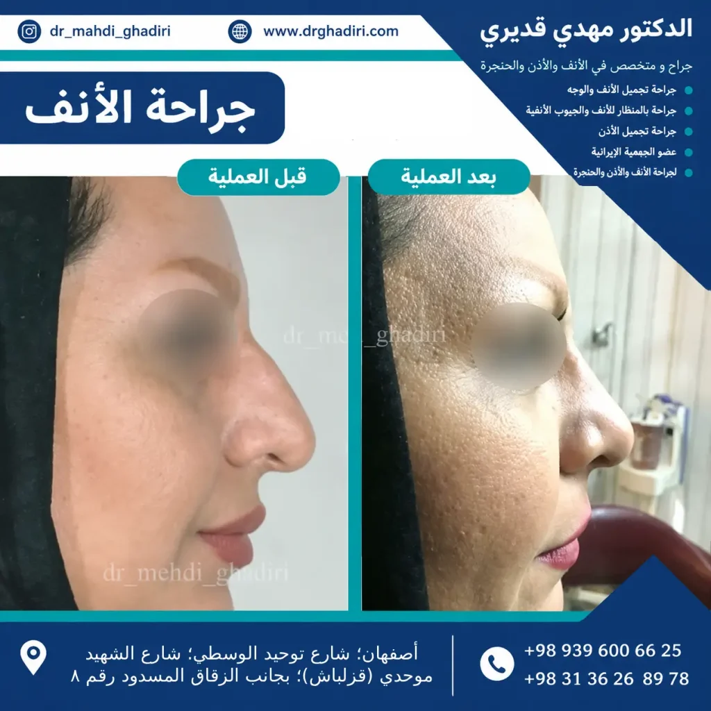 جراحة تجميل الأنف - الدكتور مهدي قديري