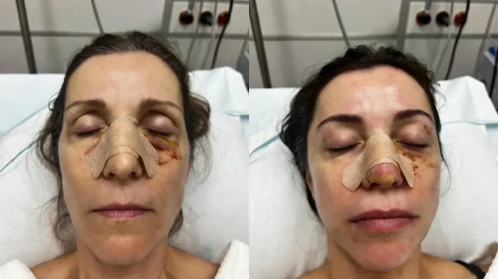 العمر المناسب لعملية تجميل الأنف -الشباب أم سنّ النضج؟