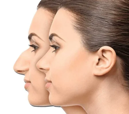 کاهش تورم و کبودی پس از جراحی بینی